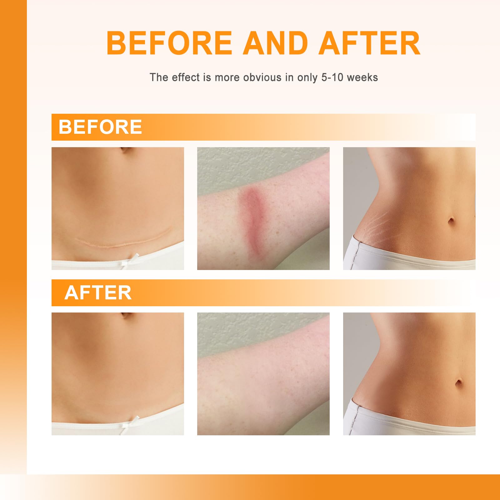 Silicone Scar Sheets (1" x 60"Roll), Soft Silicone Scar Tape for Scars Removal, Reusable E - Image 5